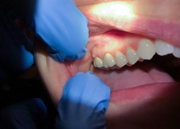 Best Emergency Dentist for Lost Fillings or Crowns in Decatur, AR